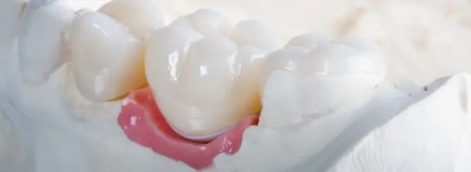 artificial model of dental crowns in Tulsa, OK